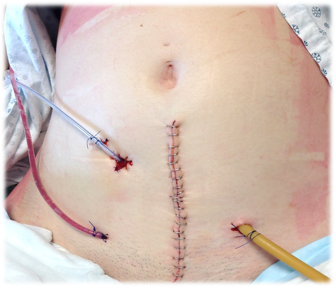 My abdomen one day after my Mitrofanoff procedure, before my bowel obstruction surgery. This image shows the incesion, the capped catheter in the Mitrofinoff channel(top left tube), superpubic catheter(right tube), and the JP drain(bottom left tube).