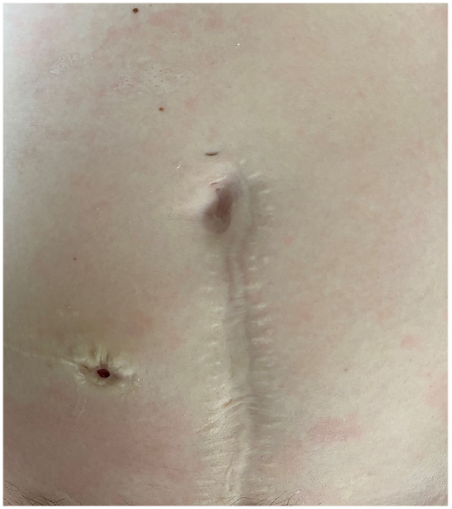 My abdomen healed 6 years after my Mitrofanoff surgery, and bowel obstruction surgery. The Mitrofanoff stoma is to the left of my midline incision, with no scarring from the superpubic catheter and JP drains that were once there.